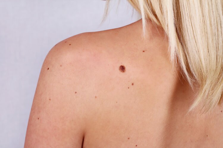 Skin Tags & Moles